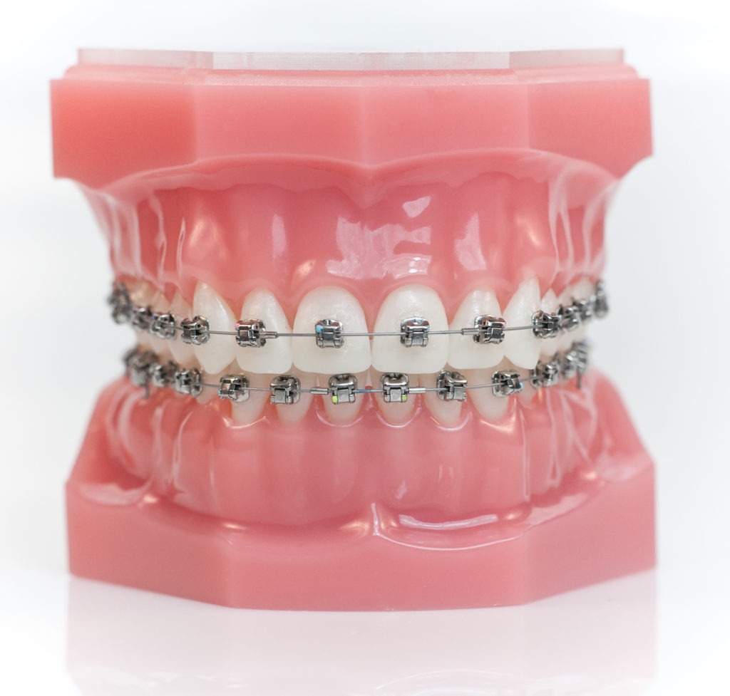 Metal Braces Braces Mebane Durham Braces Smith And Heymann 